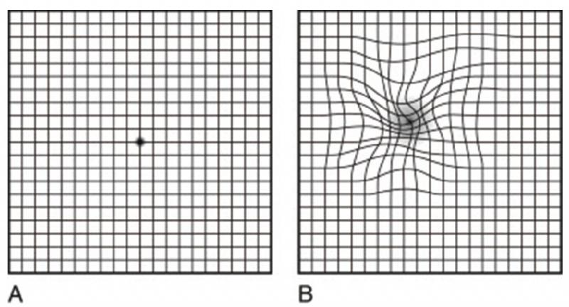 Amsler Grid