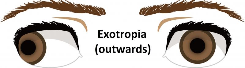 Exotropia (outwards)