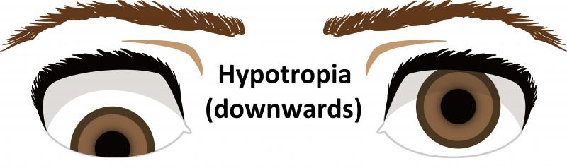 Hypotropia (downwards)