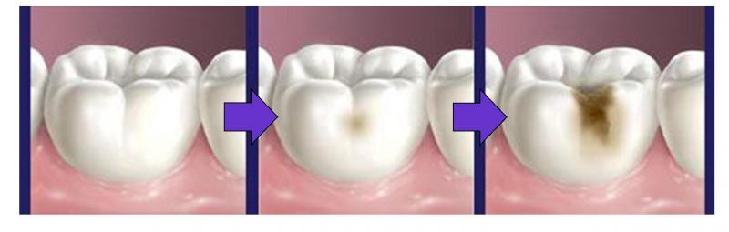 Tooth decay results from the infection with bacteria in our teeth. If it continues, the enamel in the surface of our teeth will be weakened and destroyed and forming a cavity